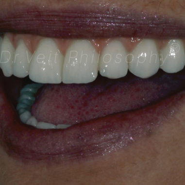 https_drveit.com.br_casos-clinicos_protocolo-de-zirconia-sobre-implantes-com-carga-imediata-6__7