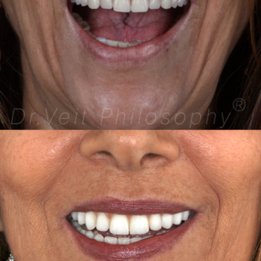 https_drveit.com.br_casos-clinicos_protocolo-de-zirconia-sobre-implantes-com-carga-imediata-6__8