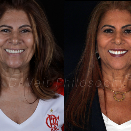 https_drveit.com.br_casos-clinicos_protocolo-de-zirconia-sobre-implantes-com-carga-imediata-6__9