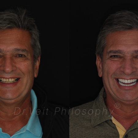 https_drveit.com.br_casos-clinicos_protocolo-de-zirconia-sobre-implantes-com-carga-imediata-7__1