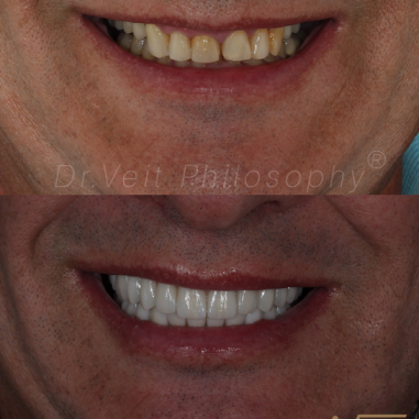 https_drveit.com.br_casos-clinicos_protocolo-de-zirconia-sobre-implantes-com-carga-imediata-7__2