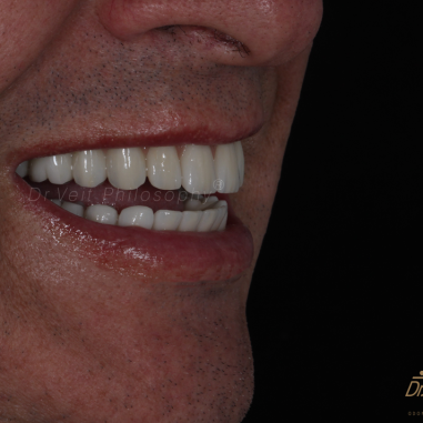 https_drveit.com.br_casos-clinicos_protocolo-de-zirconia-sobre-implantes-com-carga-imediata-7__5