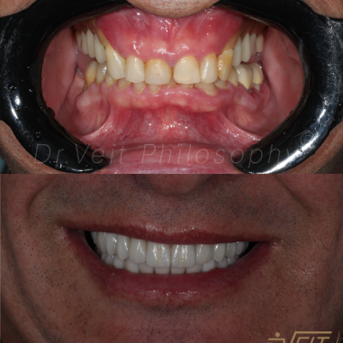 https_drveit.com.br_casos-clinicos_protocolo-de-zirconia-sobre-implantes-com-carga-imediata-7__6