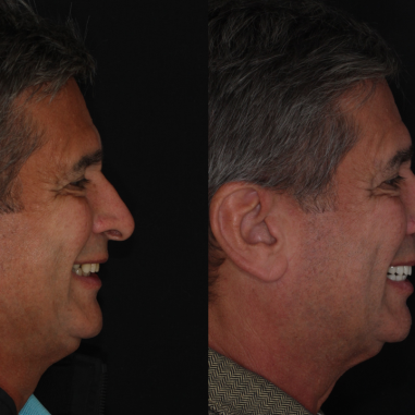 https_drveit.com.br_casos-clinicos_protocolo-de-zirconia-sobre-implantes-com-carga-imediata-7__8