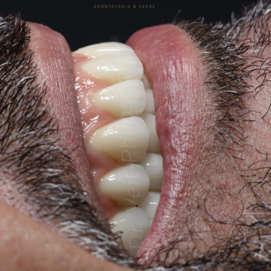 https_drveit.com.br_casos-clinicos_protocolo-de-zirconia-sobre-implantes-com-carga-imediata-8__2
