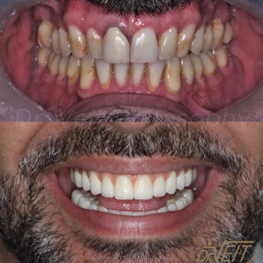 https_drveit.com.br_casos-clinicos_protocolo-de-zirconia-sobre-implantes-com-carga-imediata-8__3