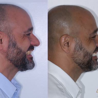 https_drveit.com.br_casos-clinicos_protocolo-de-zirconia-sobre-implantes-com-carga-imediata-8__5