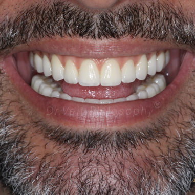 https_drveit.com.br_casos-clinicos_protocolo-de-zirconia-sobre-implantes-com-carga-imediata-8__6