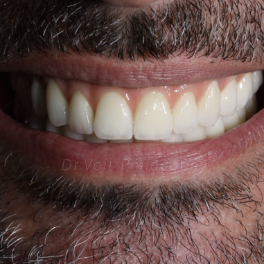 https_drveit.com.br_casos-clinicos_protocolo-de-zirconia-sobre-implantes-com-carga-imediata-8__8