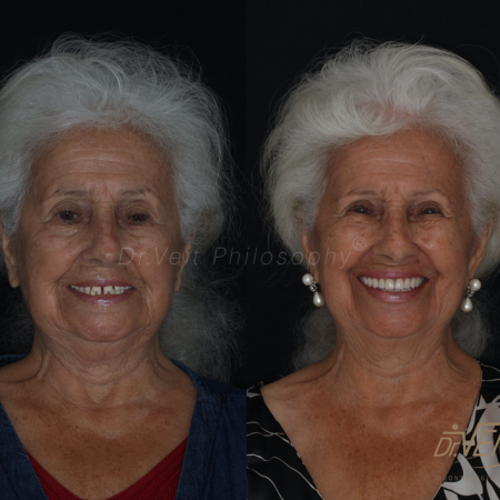 https_drveit.com.br_casos-clinicos_reabilitacao-oral-com-implantes-de-carga-imediata-10__1