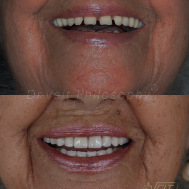 https_drveit.com.br_casos-clinicos_reabilitacao-oral-com-implantes-de-carga-imediata-10__10