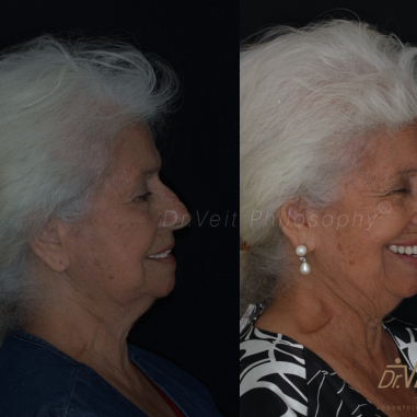 https_drveit.com.br_casos-clinicos_reabilitacao-oral-com-implantes-de-carga-imediata-10__2