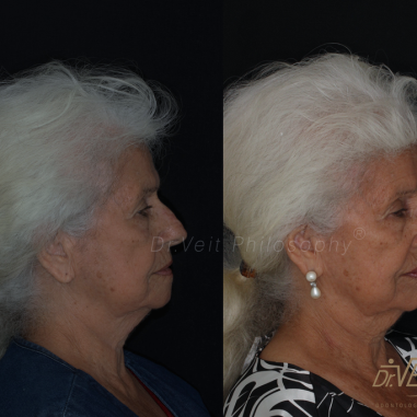 https_drveit.com.br_casos-clinicos_reabilitacao-oral-com-implantes-de-carga-imediata-10__4