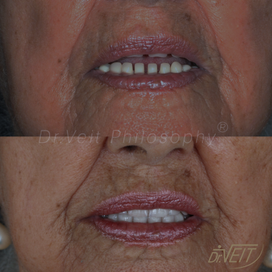 https_drveit.com.br_casos-clinicos_reabilitacao-oral-com-implantes-de-carga-imediata-10__5