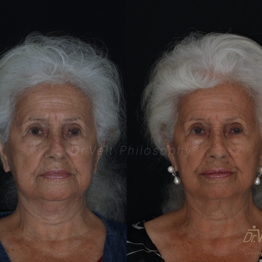 https_drveit.com.br_casos-clinicos_reabilitacao-oral-com-implantes-de-carga-imediata-10__8