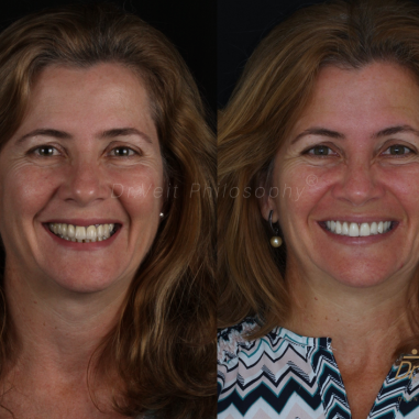 https_drveit.com.br_casos-clinicos_reabilitacao-oral-com-implantes-de-carga-imediata-11__1