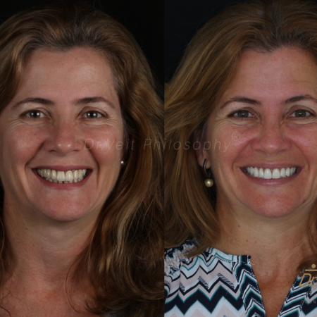 https_drveit.com.br_casos-clinicos_reabilitacao-oral-com-implantes-de-carga-imediata-11__1