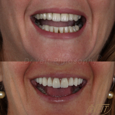 https_drveit.com.br_casos-clinicos_reabilitacao-oral-com-implantes-de-carga-imediata-11__5