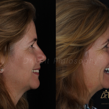 https_drveit.com.br_casos-clinicos_reabilitacao-oral-com-implantes-de-carga-imediata-11__7