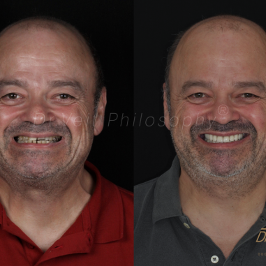 https_drveit.com.br_casos-clinicos_reabilitacao-oral-com-implantes-de-carga-imediata-13__1