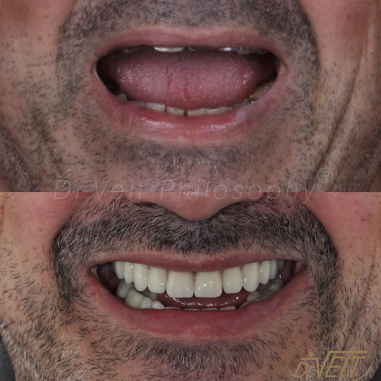 https_drveit.com.br_casos-clinicos_reabilitacao-oral-com-implantes-de-carga-imediata-13__3