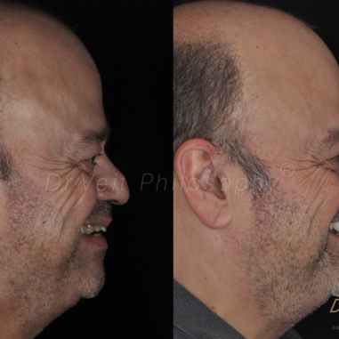 https_drveit.com.br_casos-clinicos_reabilitacao-oral-com-implantes-de-carga-imediata-13__6