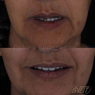 https_drveit.com.br_casos-clinicos_reabilitacao-oral-com-implantes-de-carga-imediata-14__3