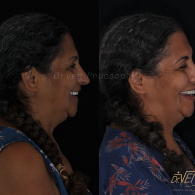 https_drveit.com.br_casos-clinicos_reabilitacao-oral-com-implantes-de-carga-imediata-14__4