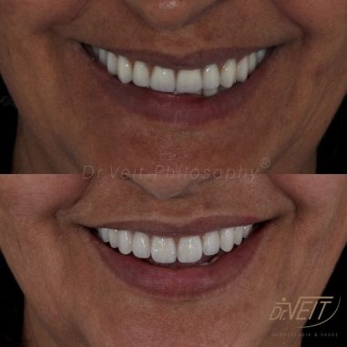 https_drveit.com.br_casos-clinicos_reabilitacao-oral-com-implantes-de-carga-imediata-14__6