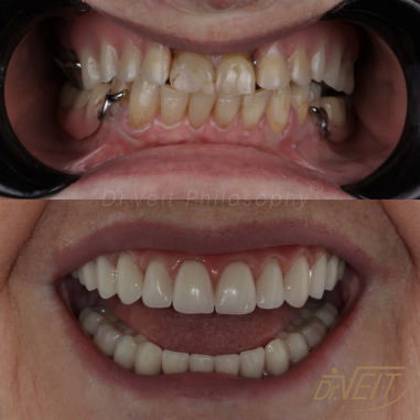 https_drveit.com.br_casos-clinicos_reabilitacao-oral-com-implantes-de-carga-imediata-15__10