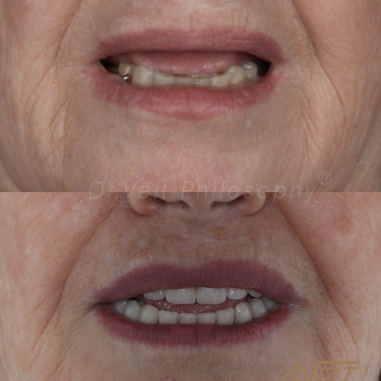 https_drveit.com.br_casos-clinicos_reabilitacao-oral-com-implantes-de-carga-imediata-15__8