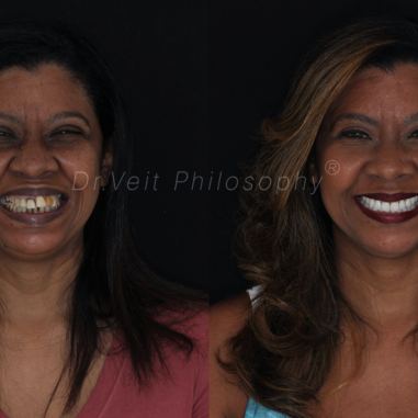 https_drveit.com.br_casos-clinicos_reabilitacao-oral-com-implantes-de-carga-imediata-16__10