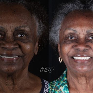 https_drveit.com.br_casos-clinicos_reabilitacao-oral-com-implantes-de-carga-imediata-17__1