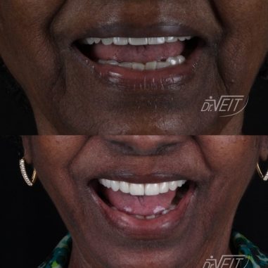 https_drveit.com.br_casos-clinicos_reabilitacao-oral-com-implantes-de-carga-imediata-17__3