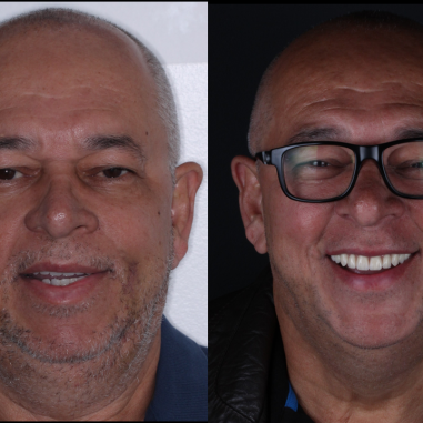 https_drveit.com.br_casos-clinicos_reabilitacao-oral-com-implantes-de-carga-imediata-18__1