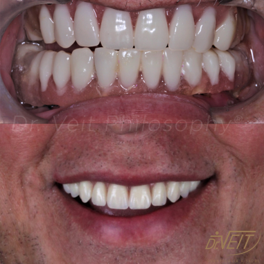 https_drveit.com.br_casos-clinicos_reabilitacao-oral-com-implantes-de-carga-imediata-18__2