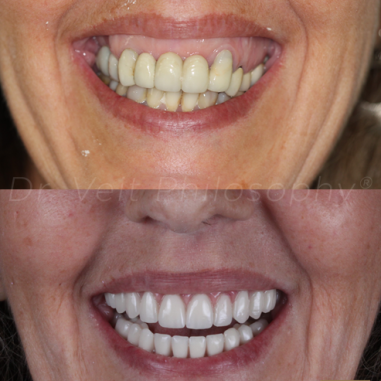 https_drveit.com.br_casos-clinicos_reabilitacao-oral-com-implantes-de-carga-imediata-19__6