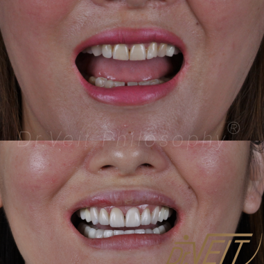 https_drveit.com.br_casos-clinicos_reabilitacao-oral-com-implantes-de-carga-imediata-20__3