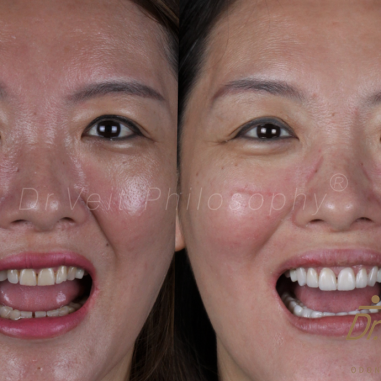 https_drveit.com.br_casos-clinicos_reabilitacao-oral-com-implantes-de-carga-imediata-20__8