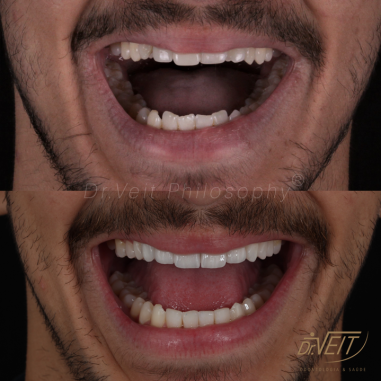 https_drveit.com.br_casos-clinicos_reabilitacao-oral-com-implantes-de-carga-imediata-21__5