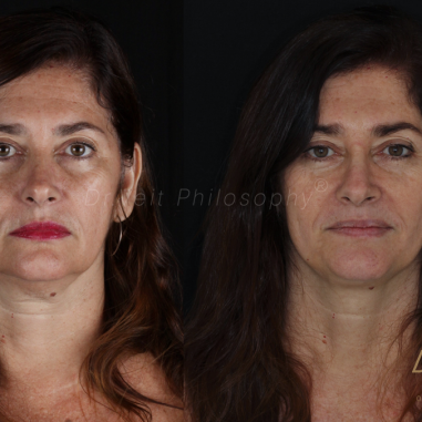 https_drveit.com.br_casos-clinicos_reabilitacao-oral-com-implantes-de-carga-imediata-3__2