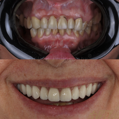 https_drveit.com.br_casos-clinicos_reabilitacao-oral-com-implantes-de-carga-imediata-3__3