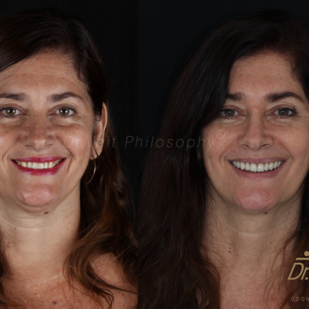 https_drveit.com.br_casos-clinicos_reabilitacao-oral-com-implantes-de-carga-imediata-3__4