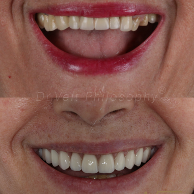 https_drveit.com.br_casos-clinicos_reabilitacao-oral-com-implantes-de-carga-imediata-3__5