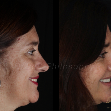 https_drveit.com.br_casos-clinicos_reabilitacao-oral-com-implantes-de-carga-imediata-3__6