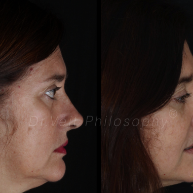 https_drveit.com.br_casos-clinicos_reabilitacao-oral-com-implantes-de-carga-imediata-3__7