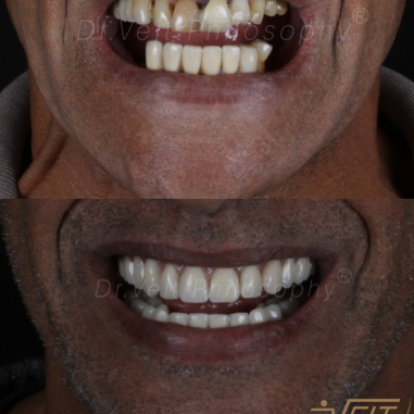 https_drveit.com.br_casos-clinicos_reabilitacao-oral-com-implantes-de-carga-imediata-4__3