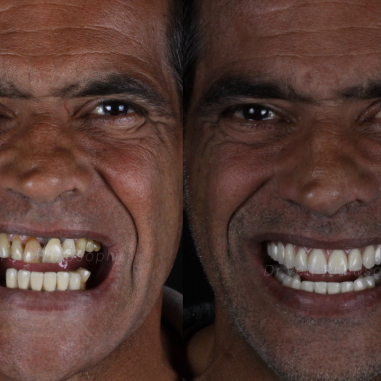 https_drveit.com.br_casos-clinicos_reabilitacao-oral-com-implantes-de-carga-imediata-4__5