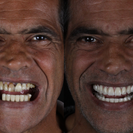 https_drveit.com.br_casos-clinicos_reabilitacao-oral-com-implantes-de-carga-imediata-4__5