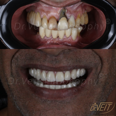 https_drveit.com.br_casos-clinicos_reabilitacao-oral-com-implantes-de-carga-imediata-4__8
